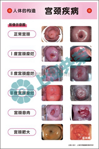 人體的構(gòu)造-宮頸疾病
